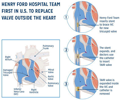Heart valve
