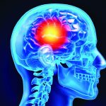 ‘BE FAST’ to recognize stroke signs Stroke signs