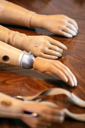 julie prentice prosthetics